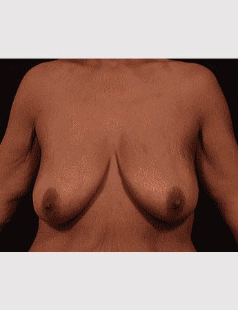 Before Image: Mastopexy (Breast Lift) - front