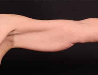 Before Image: Brachioplasty (Arm Lift) - front