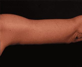 After Image: Brachioplasty (Arm Lift) - back