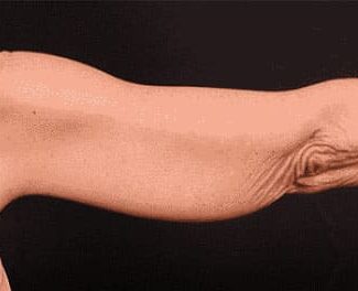 Before Image: Brachioplasty (Arm Lift) - back