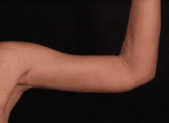 After Image: Brachioplasty (Arm Lift) - front