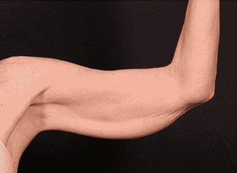 Before Image: Brachioplasty (Arm Lift) - front