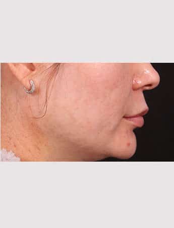 Before Image: Lip Lift - right-side