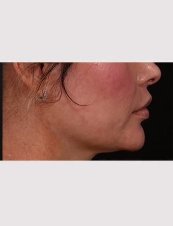 After Image: Lip Lift - right-side
