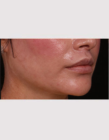 After Image: Lip Lift - right-front-oblique