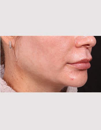 Before Image: Lip Lift - right-front-oblique