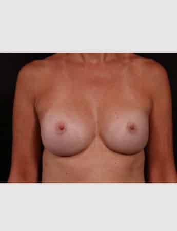 After Image: Secondary Breast Surgery - front