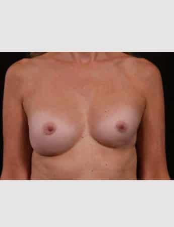 Before Image: Secondary Breast Surgery - front