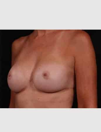 After Image: Secondary Breast Surgery - left-front-oblique