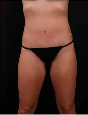 Tummy Tuck (Abdominoplasty) with Liposuction