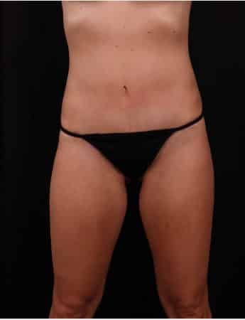 After Image: Tummy Tuck (Abdominoplasty) with Liposuction - front
