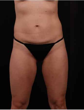 Before Image: Tummy Tuck (Abdominoplasty) with Liposuction - front