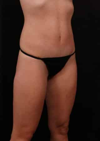 After Image: Tummy Tuck (Abdominoplasty) with Liposuction - right-front-oblique