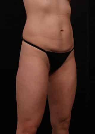 Before Image: Tummy Tuck (Abdominoplasty) with Liposuction - right-front-oblique