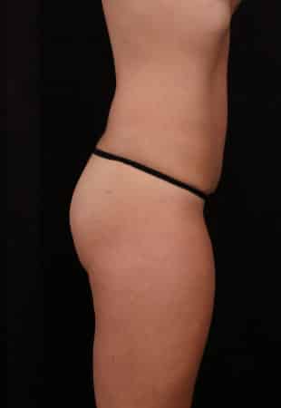 After Image: Tummy Tuck (Abdominoplasty) with Liposuction - right-side