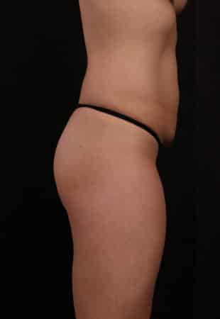 Before Image: Tummy Tuck (Abdominoplasty) with Liposuction - right-side
