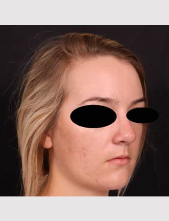 After Image: Rhinoplasty - right-front-oblique
