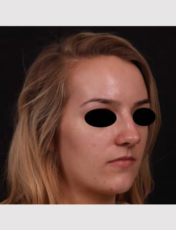Before Image: Rhinoplasty - right-front-oblique