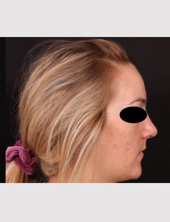 After Image: Rhinoplasty - right-side
