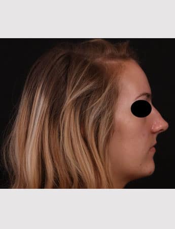 Before Image: Rhinoplasty - right-side