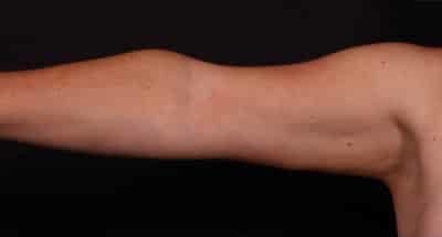 After Image: Arm Liposuction - front