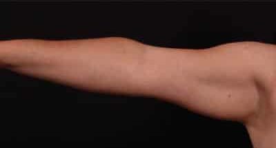 Before Image: Arm Liposuction - front
