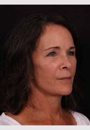 After Image: Neck Lift / Lower Facelift - right-front-oblique