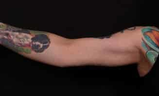 After Image: Brachioplasty (Arm Lift) - front