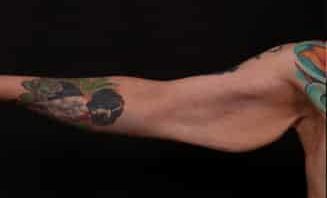 Before Image: Brachioplasty (Arm Lift) - front
