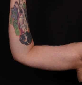 Before Image: Brachioplasty (Arm Lift) - front