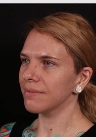 After Image: Neck Lift / Lower Facelift - left-front-oblique