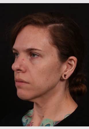Before Image: Neck Lift / Lower Facelift - left-front-oblique