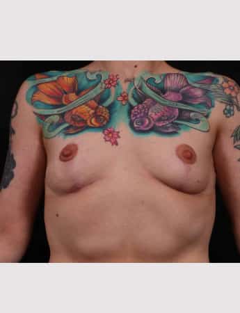After Image: Mastopexy (Breast Lift) - front
