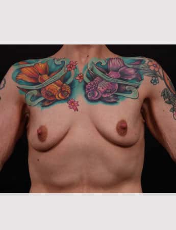 Before Image: Mastopexy (Breast Lift) - front