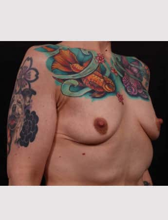 Before Image: Mastopexy (Breast Lift) - right-front-oblique