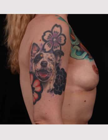 After Image: Mastopexy (Breast Lift) - right-side