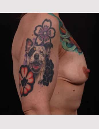 Before Image: Mastopexy (Breast Lift) - right-side