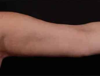 After Image: Brachioplasty (Arm Lift) - front
