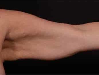 Before Image: Brachioplasty (Arm Lift) - front