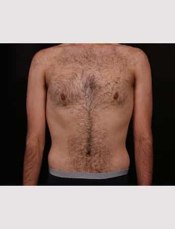 After Image: Abdominoplasty - front