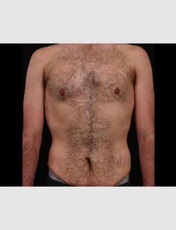Before Image: Abdominoplasty - front