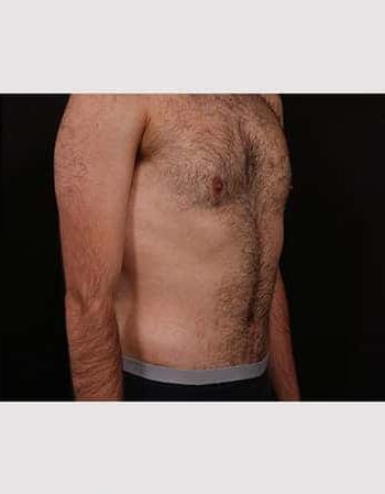 After Image: Abdominoplasty - right-front-oblique