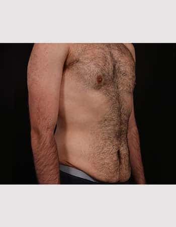 Before Image: Abdominoplasty - right-front-oblique