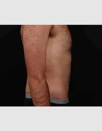 After Image: Abdominoplasty - right-side