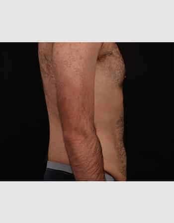 Before Image: Abdominoplasty - right-side