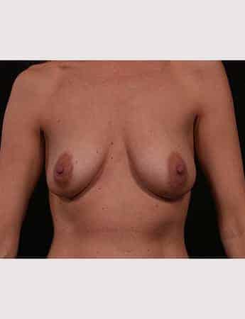 Before Image: Breast Lift (Mastopexy) with Augmentation - front