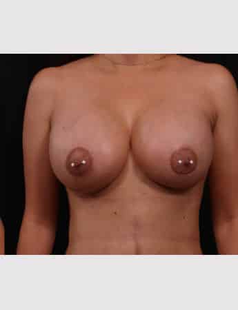 After Image: Breast Augmentation with Peri Areolar Lift - front