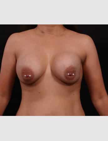 Before Image: Breast Augmentation with Peri Areolar Lift - front