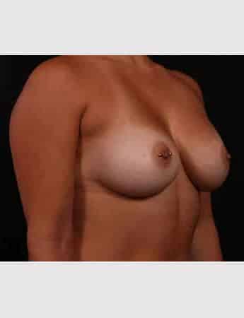 After Image: Secondary Breast Surgery - right-front-oblique