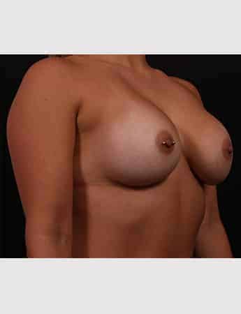Before Image: Secondary Breast Surgery - right-front-oblique